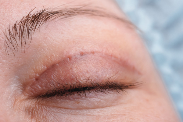 Blefaroplastia